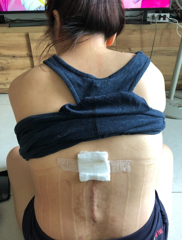 thoát vị đĩa đệm- cẩn thận lắm mà vẫn bị - học viên Thủy Garden trước khi tập trị liệu